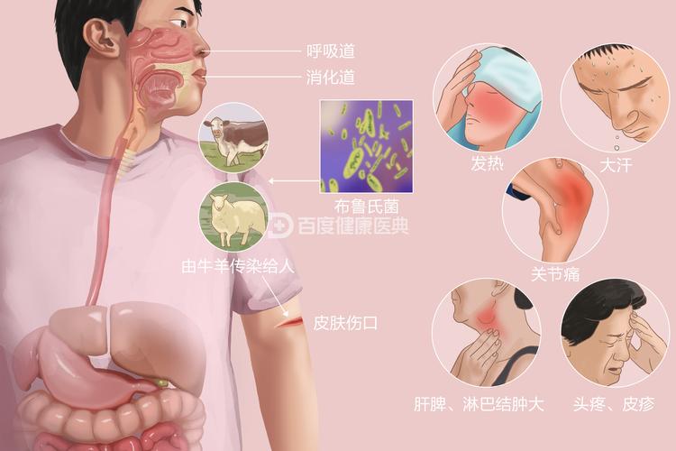 布鲁氏菌病防治技术规范有何关键要点?-图1 布鲁氏菌病防治技术规范有何关键要点?-图1